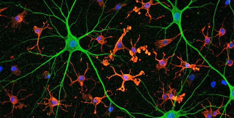 Una nueva investigación apunta a la “competencia” entre proteínas como origen del Alzheimer