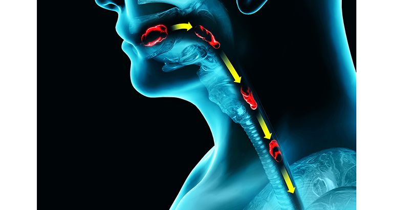 Disfagia: el trastorno oculto que pone en riesgo la salud de 2,5 millones de españoles