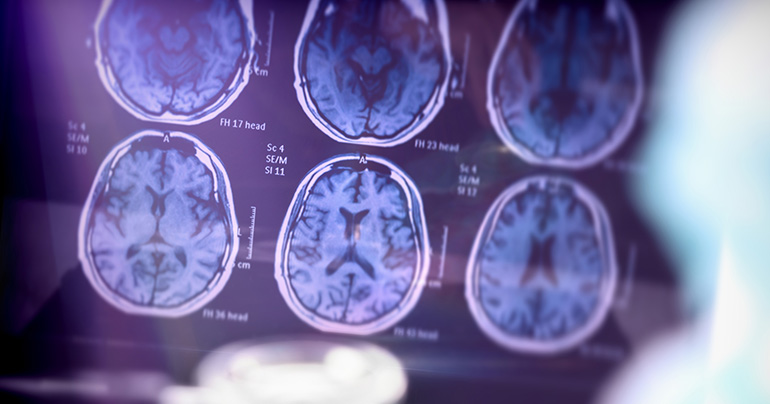 Ace Alzheimer Center Barcelona propone una estrategia nacional para incorporar las nuevas terapias contra el alzhéimer