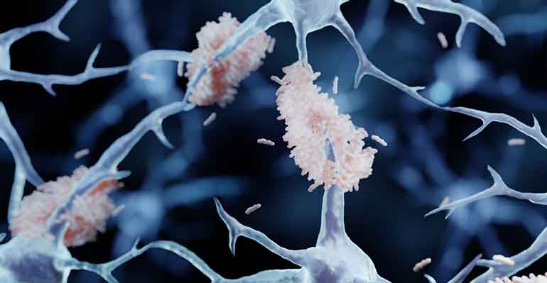 Un nuevo análisis de sangre permite avanzar en la detección precoz del Alzheimer mediante el biomarcador p-Tau217