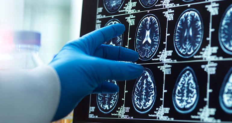 El Gobierno rechaza financiar los nuevos tratamientos contra el Alzheimer y CEAFA denuncia el abandono de los pacientes