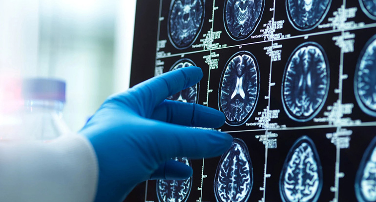La epilepsia se dispara tras la aparición del Alzheimer en adultos con síndrome de Down