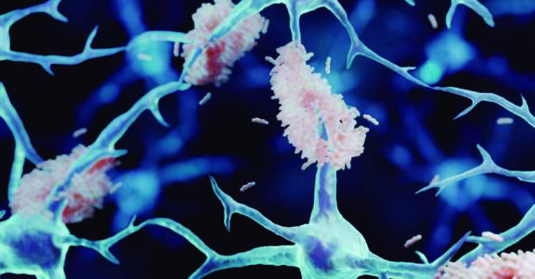 Nuevas tecnologías no invasivas ayudan a preservar la autonomía de los pacientes con Alzheimer